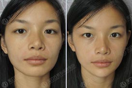 梁少琼 祛法令纹 丰下