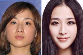 陈津津 双眼皮+微整形