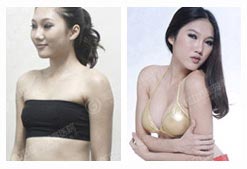 李盈 MYFUN动感隆胸