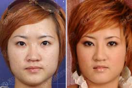 邓玉婷 韩式鼻部综合