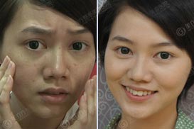 陈泓妤 祛痘祛斑